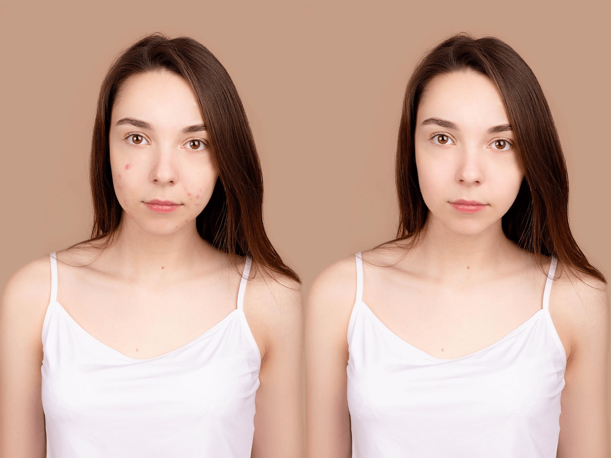 Remove Acne & Pimples in Photos on Mobile with AI Tools