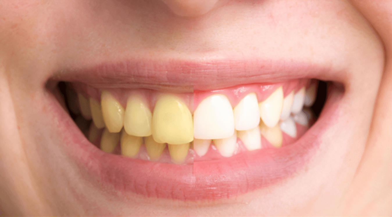 Whiten Teeth in a Photo on Mobile for Free